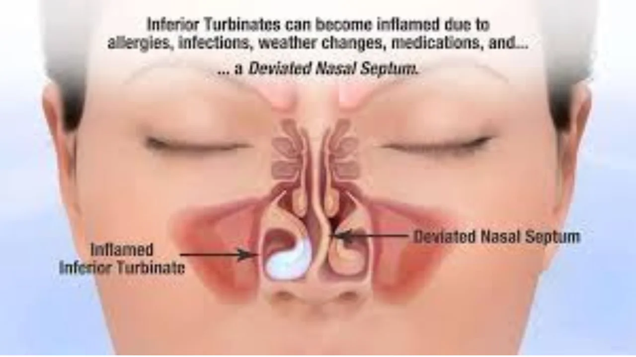 Why Do I Get Nose Blocks and Headaches in AC? Best ENT Doctor for Blocked Nose & Headaches in AC in Bangalore