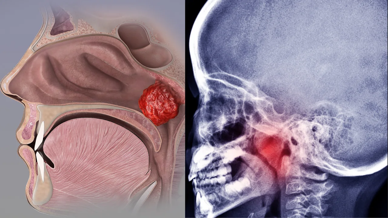 Nasal Block from Enlarged Adenoids and Its Link to ADHD in Children