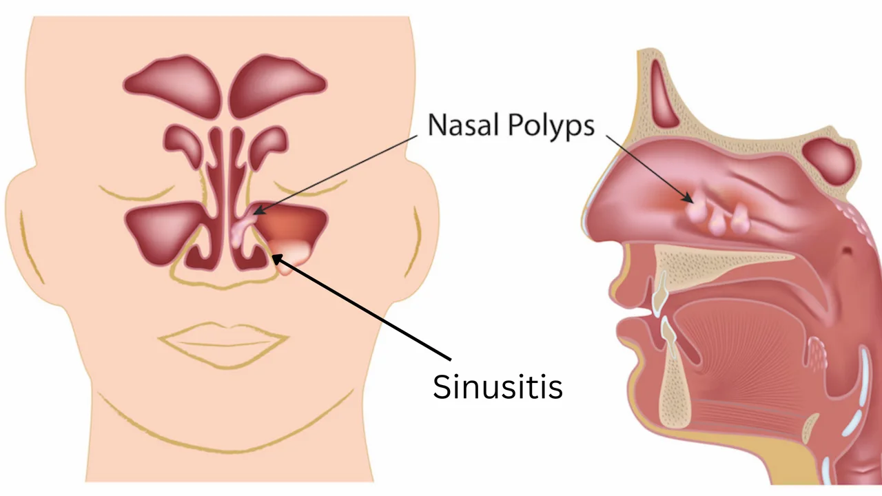 Nasal Blockage → Mouth Breathing → Recurring Throat Infections & Dry Lips