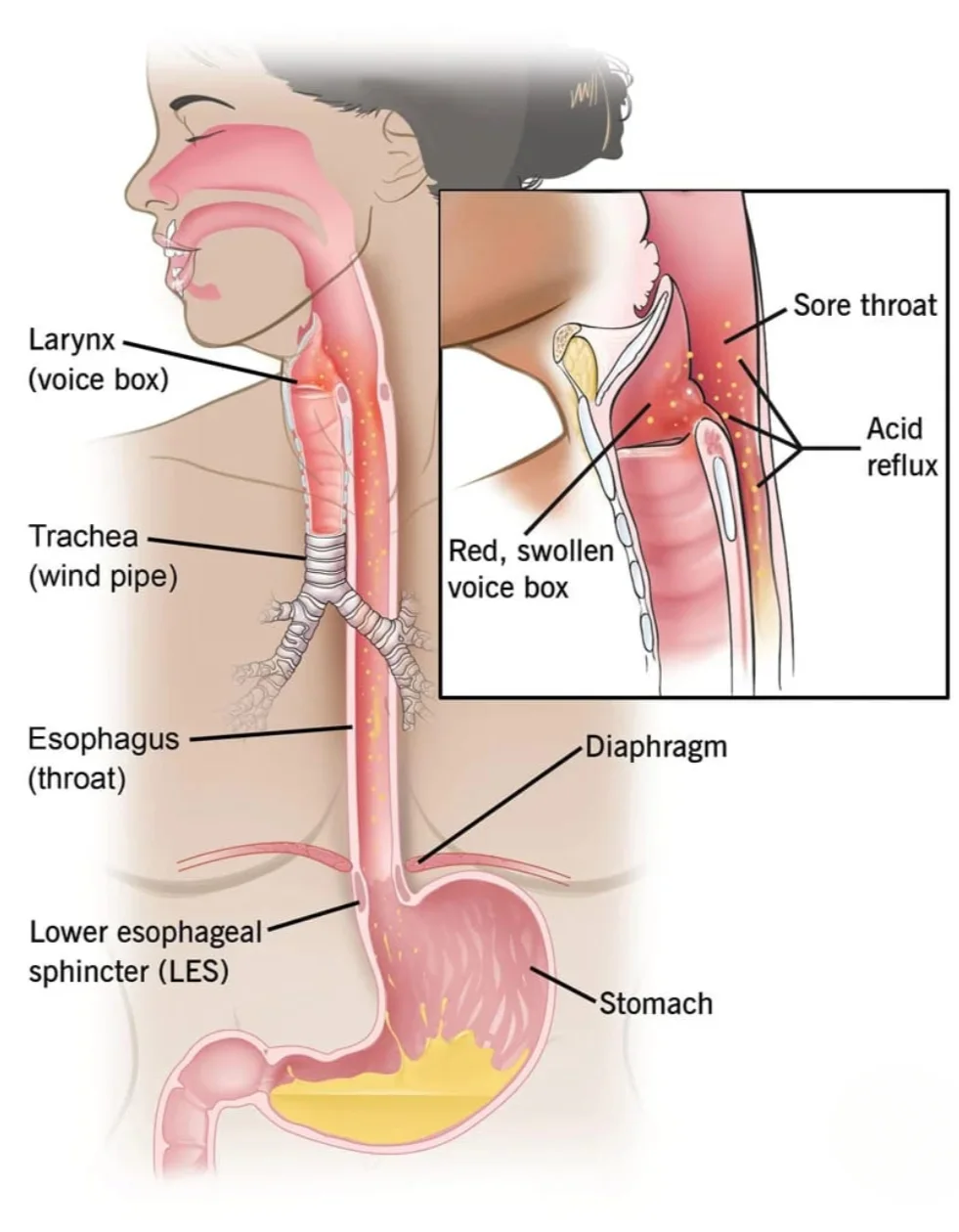 Chronic Cough? It Might Be Coming From Your Stomach — Not Your Lungs!