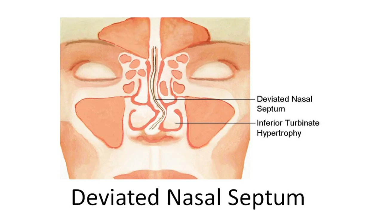 Nasal Blockage → Mouth Breathing → Recurring Throat Infections & Dry Lips